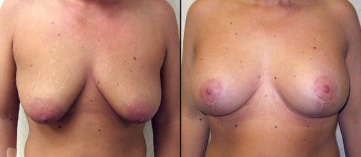 McLean, VA – Breast Lift with Implants Patient 2