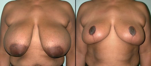 McLean, VA – Breast Reduction Patient 1